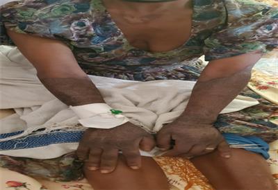 Case report: Pellagra presentation with dermatitis and dysphagia